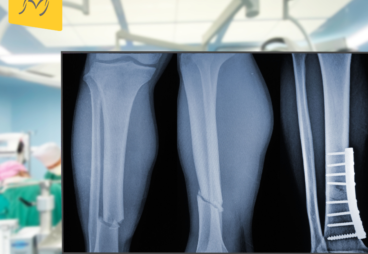 What Are Bone Plates Understanding Their Importance in Modern Surgery