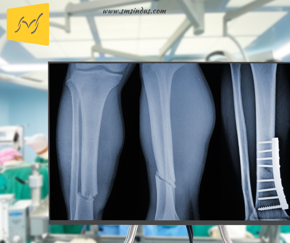 What Are Bone Plates Understanding Their Importance in Modern Surgery